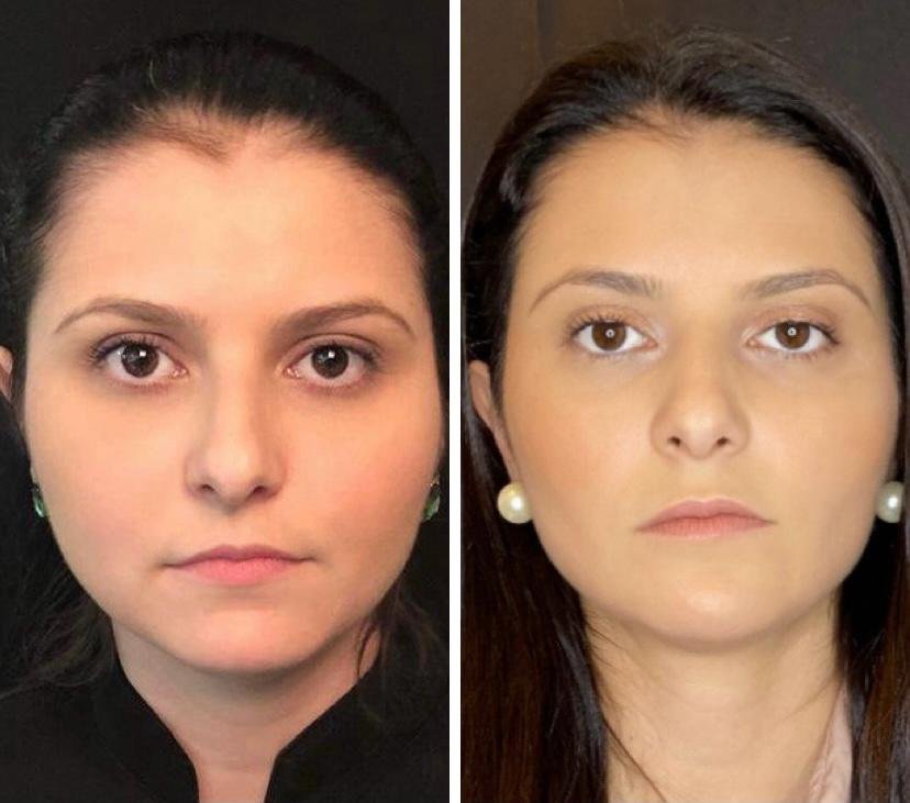 Antes e depois de bichectomia e contorno facial com a Dra. Walkiria Oliveira