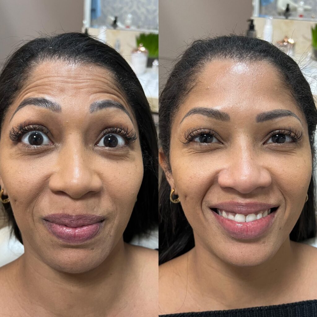 Antes e depois de toxina botulínica full face com a Dra. Walkiria Oliveira