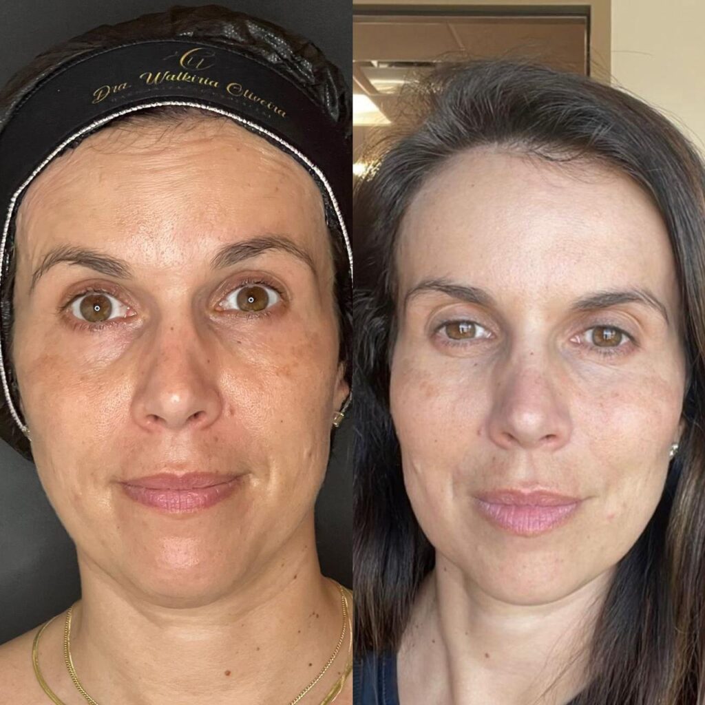 Antes e depois de harmonização facial Método Harmonia Lifting com a Dra. Walkiria Oliveira