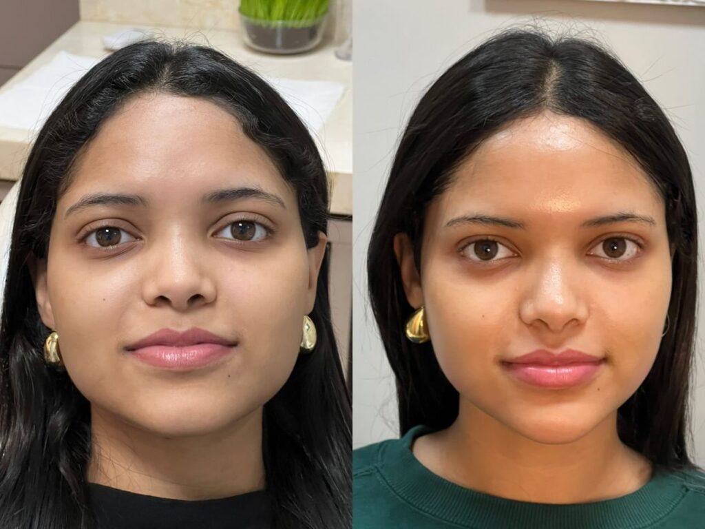 Antes e depois de harmonização facial com a Dra. Walkiria Oliveira