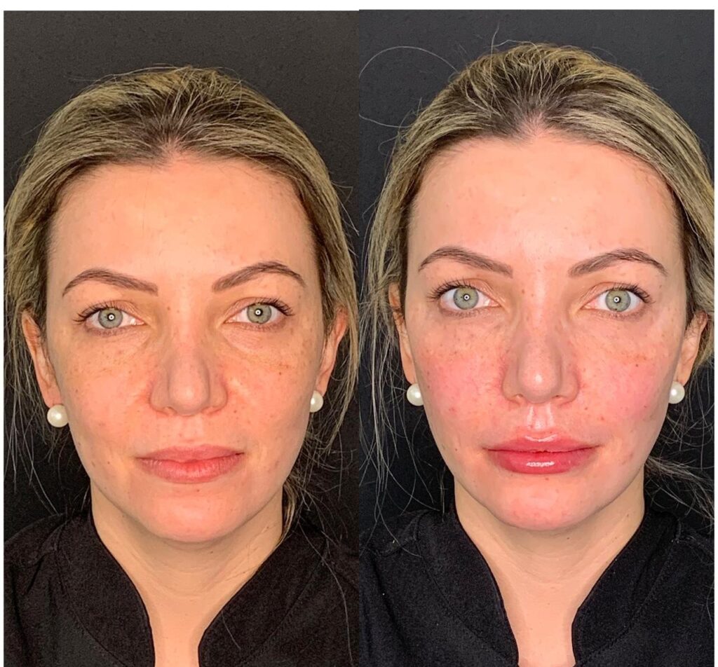 Antes e depois de harmonização facial e preenchimento labial com a Dra. Walkiria Oliveira