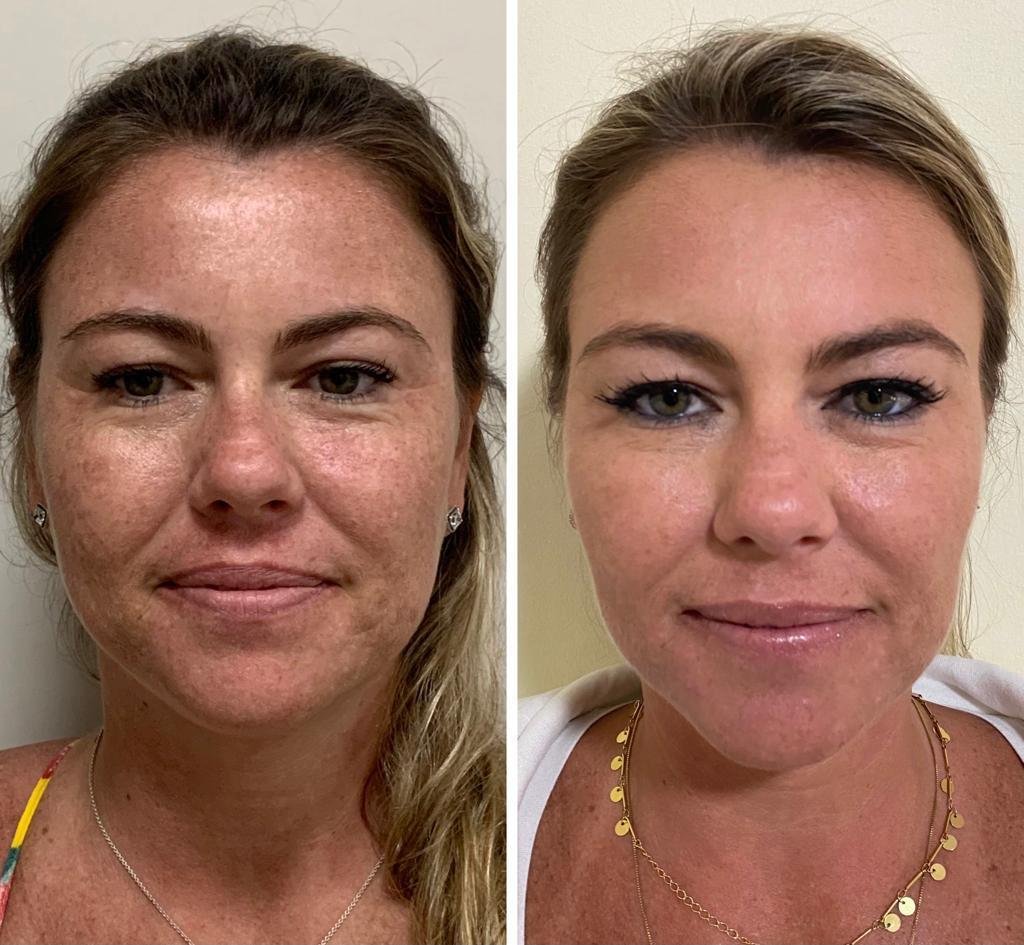 Antes e depois de harmonização facial e rejuvenescimento da pele com a Dra. Walkiria Oliveira