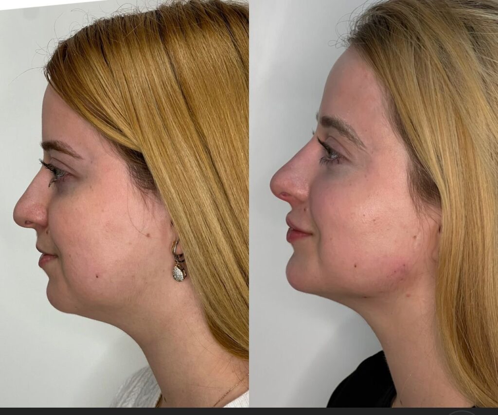Antes e depois de preenchimento de mento e mandíbula com a Dra. Walkiria Oliveira