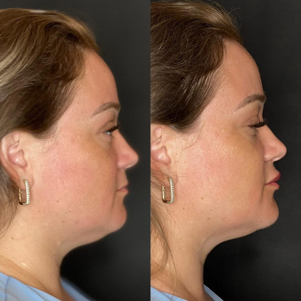 Antes e depois de harmonização de mandíbula e perfil com a Dra. Walkiria Oliveira