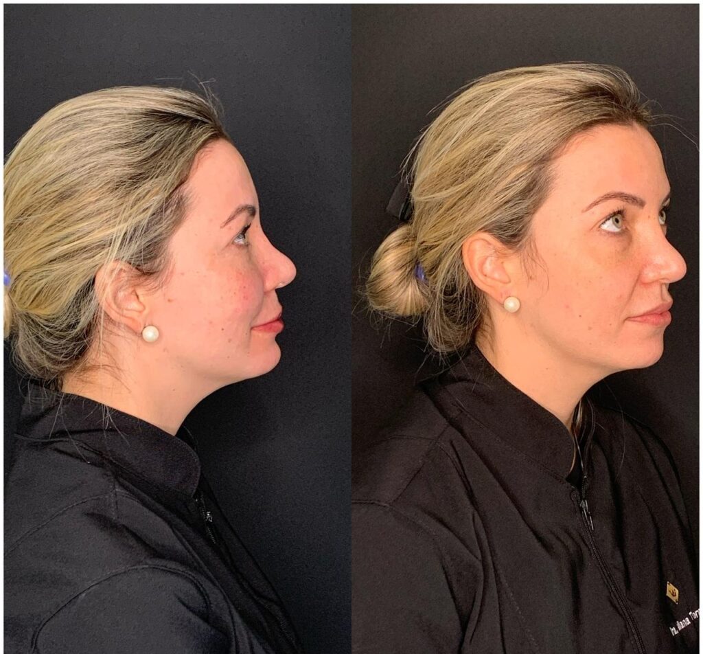 Antes e depois de harmonização de mandíbula e perfil com a Dra. Walkiria Oliveira