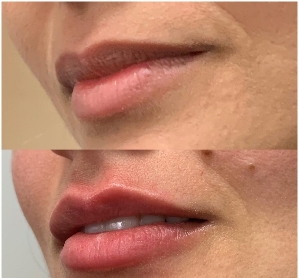 Antes e depois de preenchimento labial com a Dra. Walkiria Oliveira