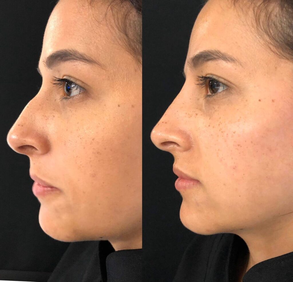 Antes e depois de rinomodelação com a Dra. Walkiria Oliveira