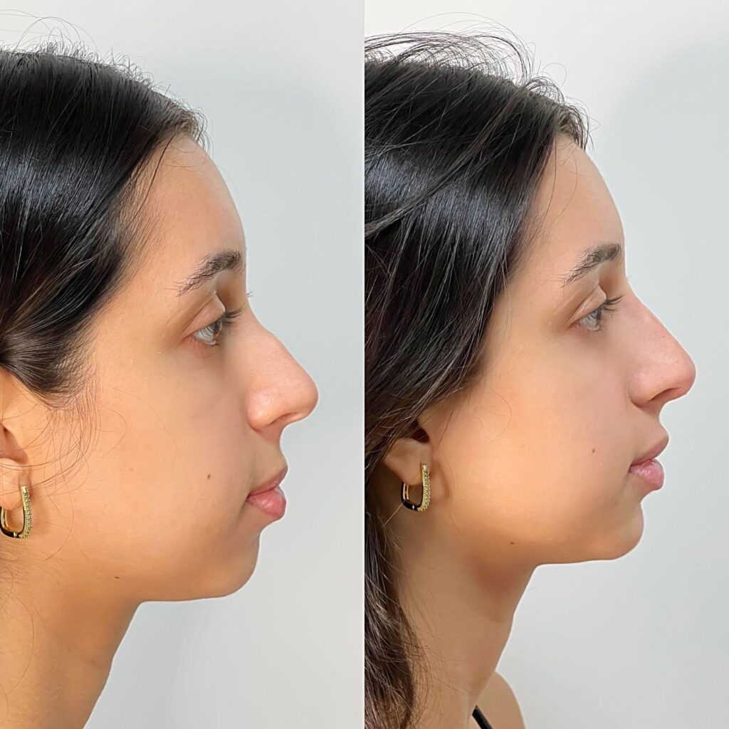 Antes e depois de rinomodelação com a Dra. Walkiria Oliveira