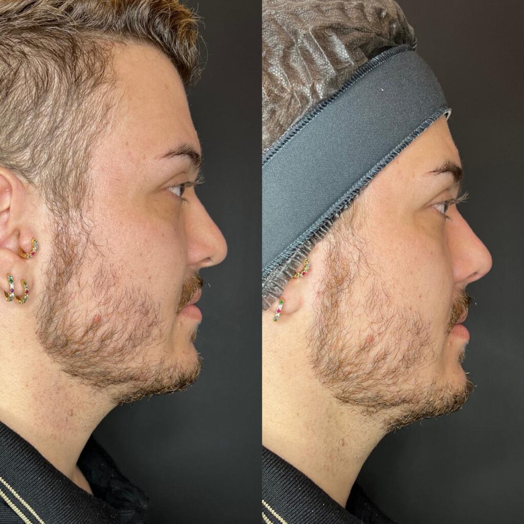 Antes e depois de rinomodelação masculina com a Dra. Walkiria Oliveira